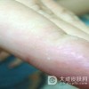 汗疱疹是传染性疾病吗