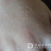 患有汗疱疹要怎么治疗呢
