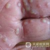 哪些因素可以诱发汗疱疹呢