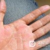 手癣的临床表现特点是什么