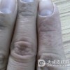 手癣要怎么鉴别诊断呢