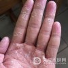 患有手癣后有什么影响呢
