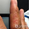 治疗手癣的方法一般有哪些