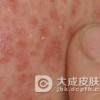 异位性皮炎会出现的原因是什么