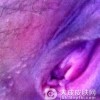 女性尖锐湿疣潜伏期的症状有什么