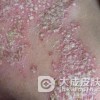 单纯性痒疹的护理方法有哪些