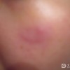 预防红斑狼疮的好方法