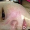 红斑狼疮患者不能吃什么食物呢