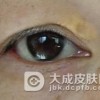 怎么确诊黄瘤病呢