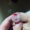 甲沟炎应该怎么预防呢