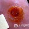 哪些因素会造成鸡眼的发生