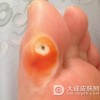 治疗鸡眼的五种辅助方法是什么