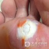 鸡眼的诱发因素包括哪些