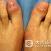 如何区分牛皮癣与扁平苔藓、慢性湿疹