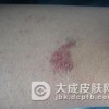 牛皮癣和扁平苔癣要怎样区分呢