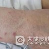 与扁平苔癣相伴的疾病