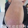 牛皮癣和扁平苔藓怎么区别