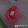 鸡眼可以用手术治愈吗