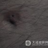 患有痈的症状是什么呢
