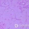 副银屑病患者有那些发病特点