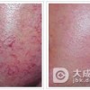 红血丝应该吃什么才好
