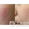 去红血丝绿豆的偏方