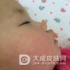 一些荨麻疹型药疹的症状