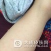 荨麻疹型药疹都有哪些的症状