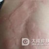 荨麻疹型药疹症状的表现都有那些
