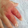蔓状血管瘤要如何治疗