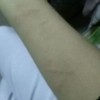 急性荨麻疹不能吃什么食物