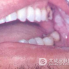 黏膜白斑有什么鉴别疾病