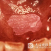 黏膜白斑有什么主要症状
