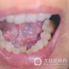 口腔黏膜白斑引起的损害有哪些