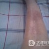 春季到来局限性硬皮病需要注意什么