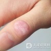 局限性硬皮病是什么病