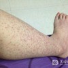 小儿过敏性紫癜要做那些预防呢？