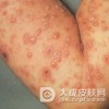 哪个年龄段最容易出现水痘？