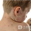 如何有效的护理水痘患儿？