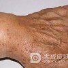 哪些因素会导致出现老年斑