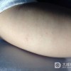 传染性软疣会出现的危害是哪些