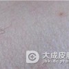 传染性软疣的传染方式