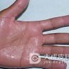 多汗症有哪些的护理的方法