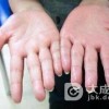 小儿多汗症是怎么回事