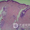 扁平寻常狼疮养成好的饮食习惯
