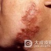 寻常狼疮有哪些治疗措施