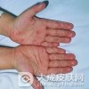 手足口病与哪些疾病鉴别
