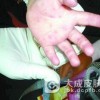 手足口病应与哪些疾病区分