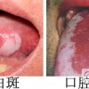 口腔白斑是什么的原因引起的