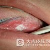 引起口腔白斑的原因都是什么